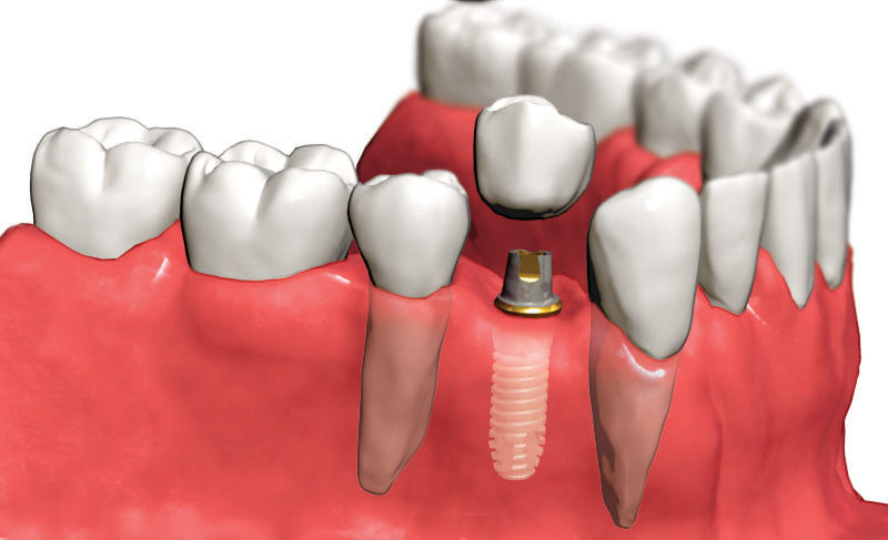 Имплантация зубов: преимущества и уход